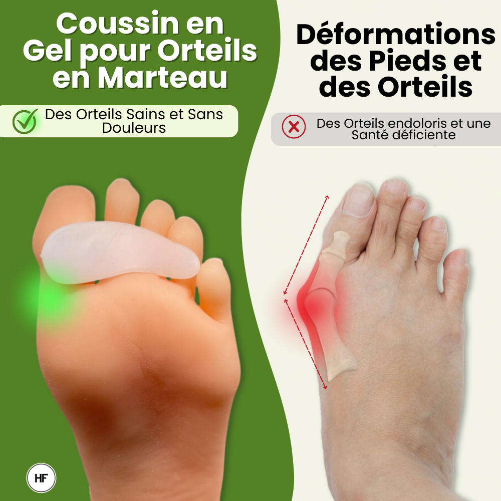 Coussin en Gel HF pour Orteils en Marteau - Alignement des Orteils et Soulagement de la Douleur